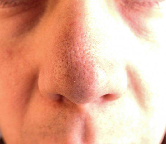 Punti neri sul naso: ecco un metodo semplice per eliminarli