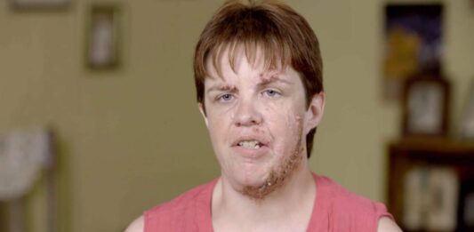 La dottoressa Pimple Popper, Monica vittima di bullismo: incredibile dramma, cos’è successo