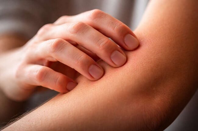 Scoperto il segreto del prurito